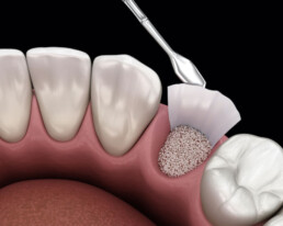 Bone graft teeth surgery Dr Mehmet Oztel