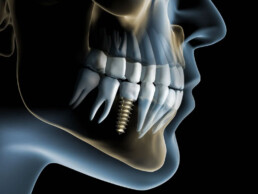Dental implant surgery Dr Mehmet Oztel Brisbane
